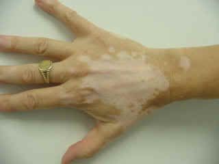 vitiligo.jpg